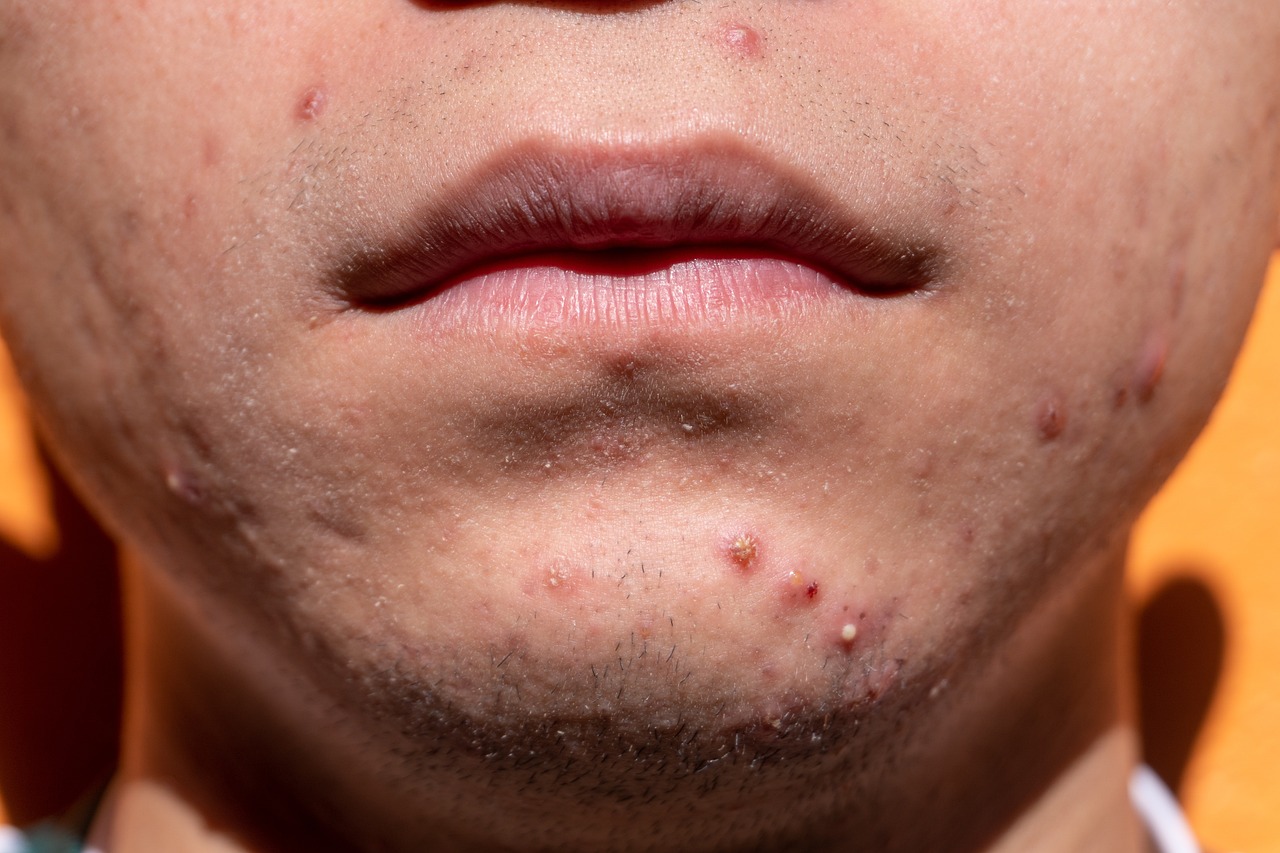 acne, shin, dermatology, skin, puberty, teen, young, treatment, medicine, sickness, remedy, health, cosmetics, acne, acne, acne, acne, acne-6822174.jpg